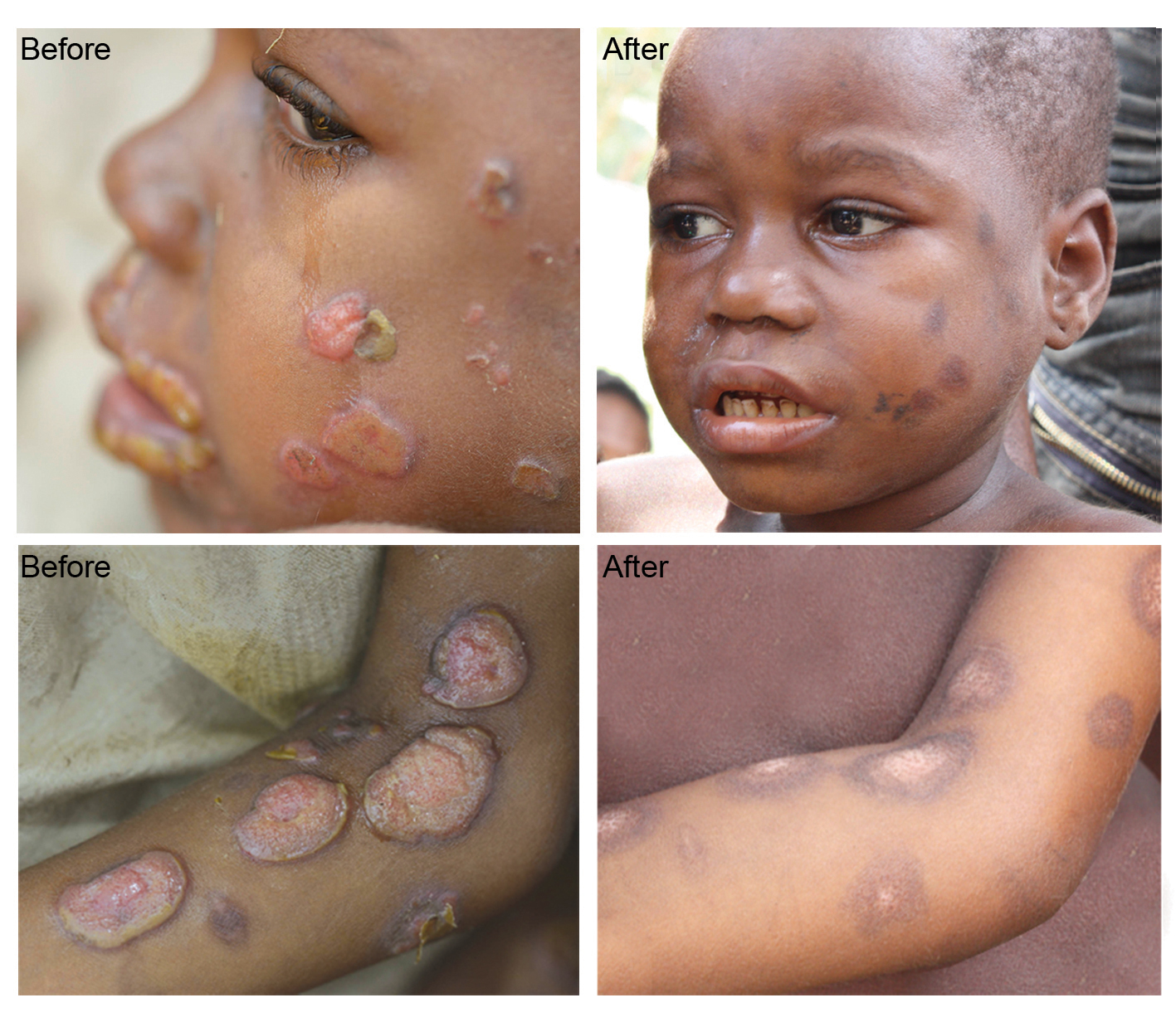 Treatment_results_with_azithromycin_congo